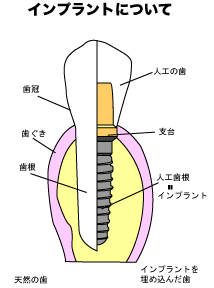 implant